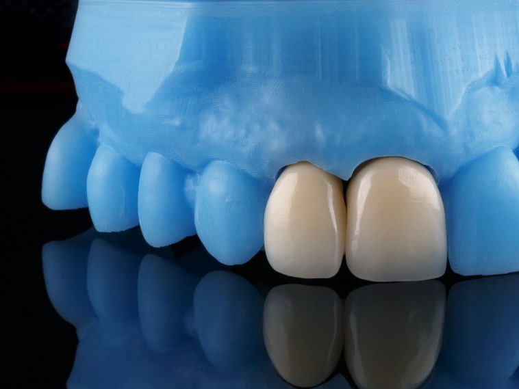 Dentist Ripon
Digital dentistry crowns on model